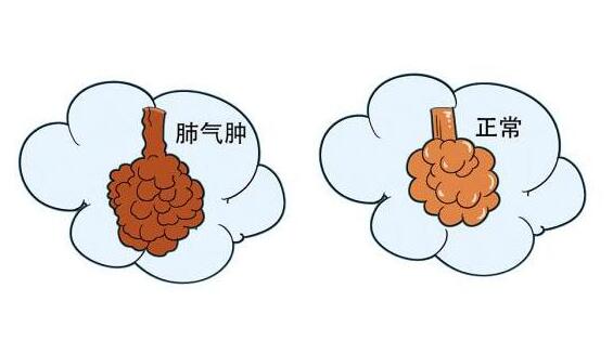 什么是肺氣腫?肺氣腫嚴(yán)重嗎?