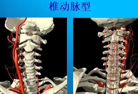 椎動(dòng)脈型頸椎病診斷標(biāo)準(zhǔn)