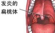 急性扁桃體炎 急性扁桃體炎