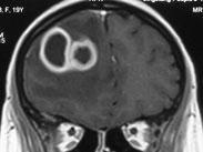耳源性腦膿腫 耳源性腦膿腫