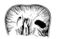 膈先天性缺損 膈先天性缺損