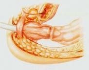 肛管、直腸、結(jié)腸狹窄 肛管、直腸、結(jié)腸狹窄