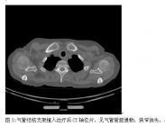 氣管、支氣管狹窄
