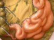 急性腸系膜淋巴結(jié)炎 急性腸系膜淋巴結(jié)炎