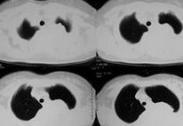 惡性胸腔積液 惡性胸腔積液
