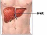 原發性膽汁性肝硬化 原發性膽汁性肝硬化