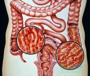 潰瘍性結腸炎性關節炎 潰瘍性結腸炎性關節炎