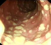 假膜性腸炎 假膜性腸炎