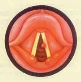 食管損傷 食管損傷
