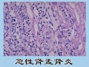 急性腎盂腎炎