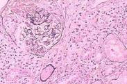 非甾體類抗炎藥物性腎病
