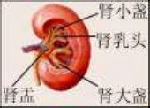 腎盞憩室
