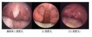 阻塞性睡眠呼吸暫停綜合征 阻塞性睡眠呼吸暫停綜合征