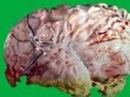 急性化膿性腦膜炎 急性化膿性腦膜炎