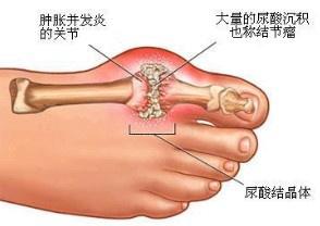 痛風