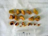 膽囊結石