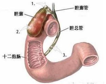 膽囊炎 膽囊炎