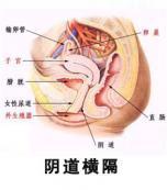 陰道橫隔 陰道橫隔