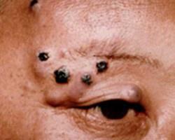大汗腺癌 大汗腺癌