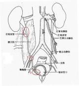 輸尿管結石 輸尿管結石