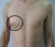 男性乳腺發育癥 男性乳腺發育癥