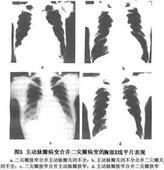 二尖瓣和主動脈瓣的疾患 二尖瓣和主動脈瓣的疾患