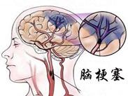 腦梗塞 腦梗塞