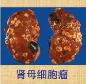 腎母細(xì)胞瘤 腎母細(xì)胞瘤