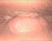 肛周膿腫