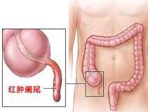 闌尾炎 闌尾炎