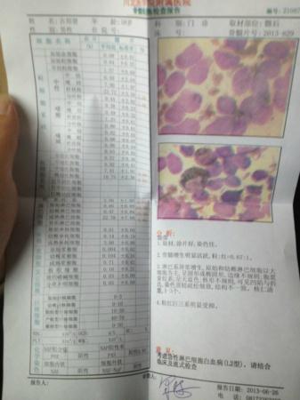 急性淋巴細(xì)胞白血病 急性淋巴細(xì)胞白血病
