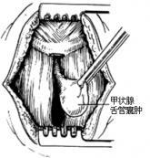 甲狀腺舌管囊腫與瘺 甲狀腺舌管囊腫與瘺