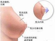 閉經溢乳綜合征 閉經溢乳綜合征