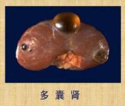 多囊腎 多囊腎