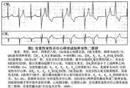 室性逸搏及室性逸搏心律 室性逸搏及室性逸搏心律