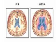 高原腦水腫 高原腦水腫