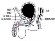 膀胱上內(nèi)疝 膀胱上內(nèi)疝