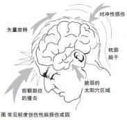 腦震蕩 腦震蕩