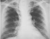 胸內甲狀腺腫 胸內甲狀腺腫
