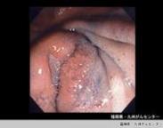 膽囊平滑肌肉瘤 膽囊平滑肌肉瘤
