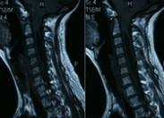 小兒后顱窩型腦積水綜合征 小兒后顱窩型腦積水綜合征
