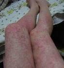 皮膚腦膜瘤