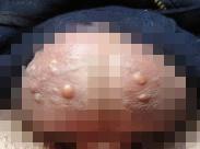 陰莖陰囊象皮腫 陰莖陰囊象皮腫