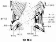 腰疝 腰疝