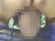 陰囊絲蟲病