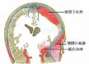 腦挫裂傷 腦挫裂傷