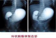 環(huán)狀胰腺 環(huán)狀胰腺