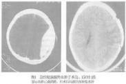 硬腦膜外血腫 硬腦膜外血腫