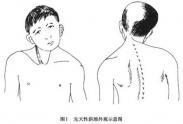 先天性斜頸 先天性斜頸