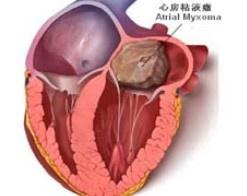 心臟粘液瘤 心臟粘液瘤